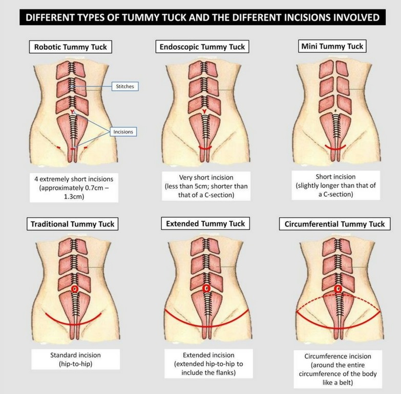 Types of Tummy Tuck Surgery